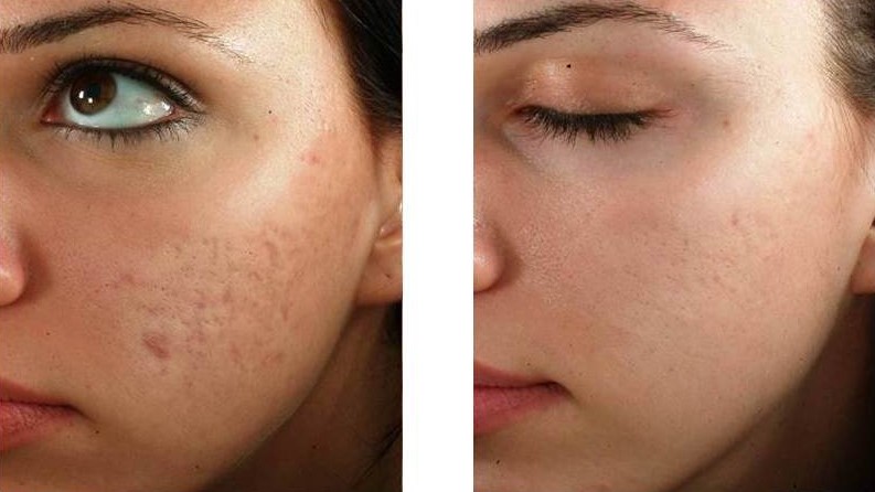 Microneedling-Collagen-stimulation-therapy Los Angeles