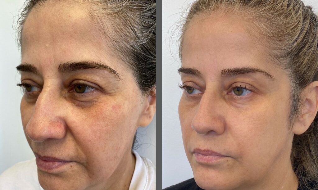 Morpheus8-Before-and-After-non-invasive-skin-care-treatment Los Angeles