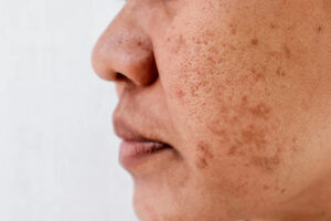 Pigmentation on Face Los Angeles 