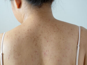 acne dark spots on the back Los Angeles