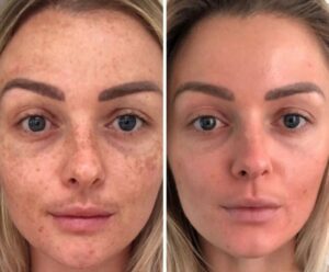 cosmelan peel before-after Los Angeles 