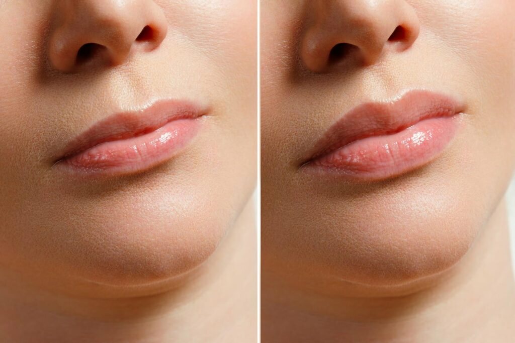 lip-filler-injections Los Angeles