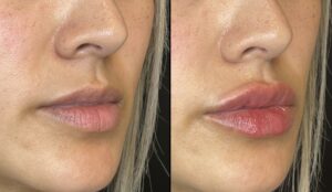 lip fillers before-after Los Angeles