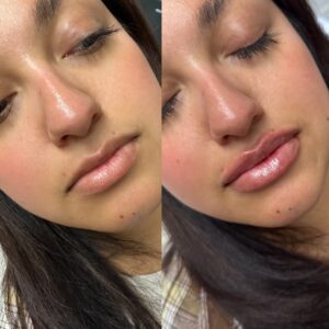 Lip filler Los Angeles