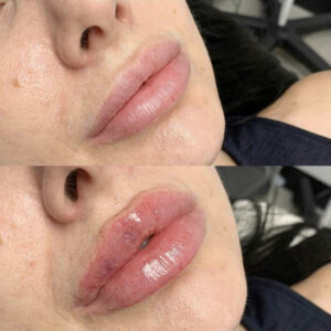 lip-injections-before-after Los Angeles