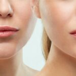 lip plumping with fillers Los Angeles