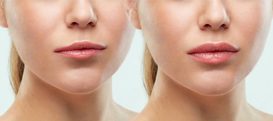 lip plumping with fillers Los Angeles