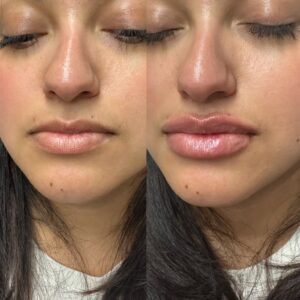 Lip filler Los Angeles