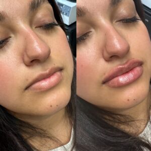 lip injection before after Los Angeles