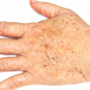 pigment spots on hands Los Angeles 