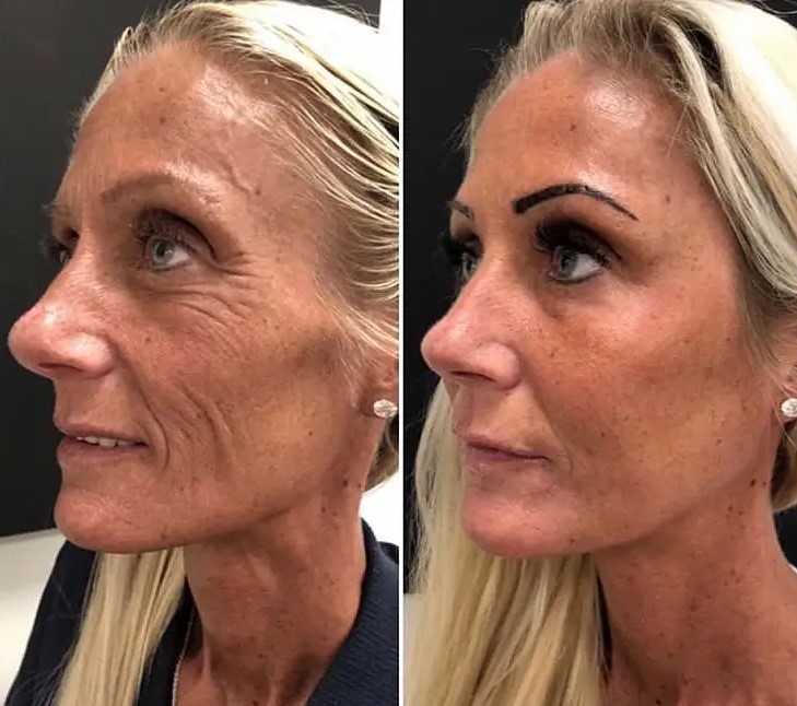 Dermal fillers for loose skin before-after Los Angeles