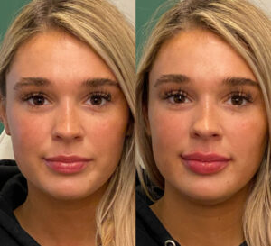 Lip enhancement before-after Los Angeles