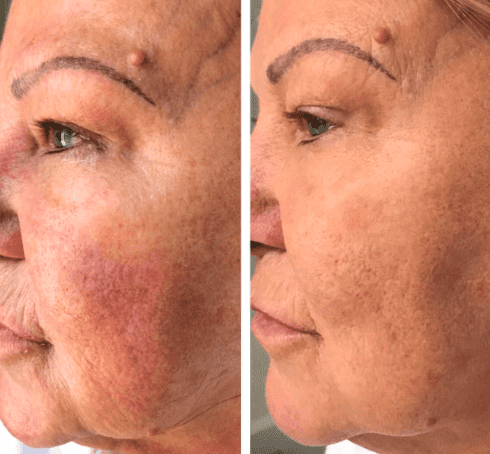 Platelet-rich plasma facelift Los Angeles