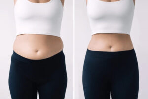 belly fat treatment with Morpheus8 before-after Los Angeles