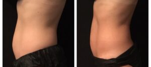 belly skin tightening with Morpheus8 Los Angeles