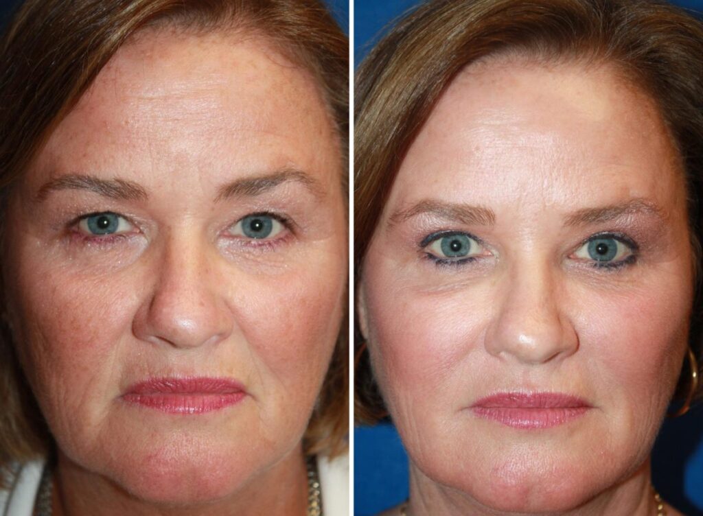 chemical-peel-before-after-crepey skin treatment Los Angeles