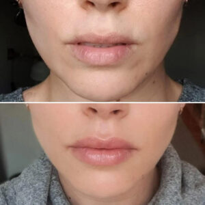 lip filler before-after Los Angeles