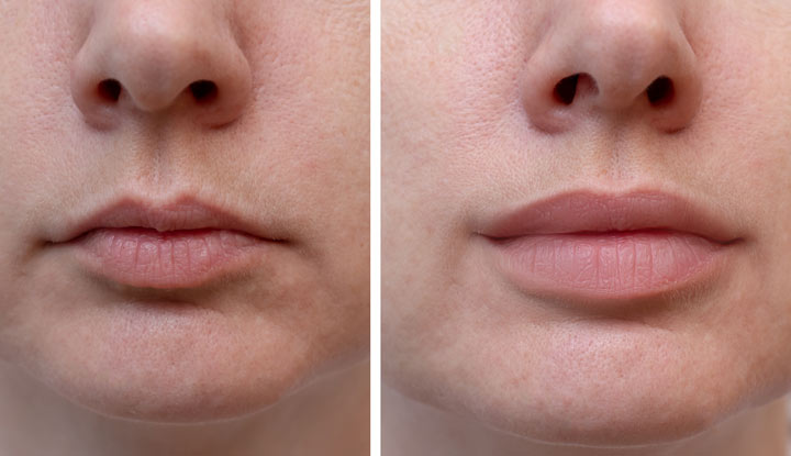 lip line dermal filler Los Angeles