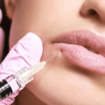 lip line injections Los Angeles