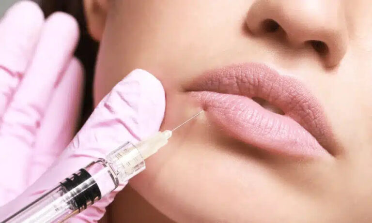 lip line injections Los Angeles