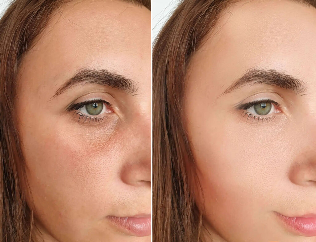 morpheus8-for fine lines before-after Los Angeles