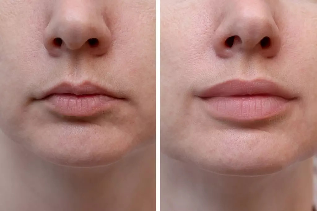 natural lip augmentation Los Angeles