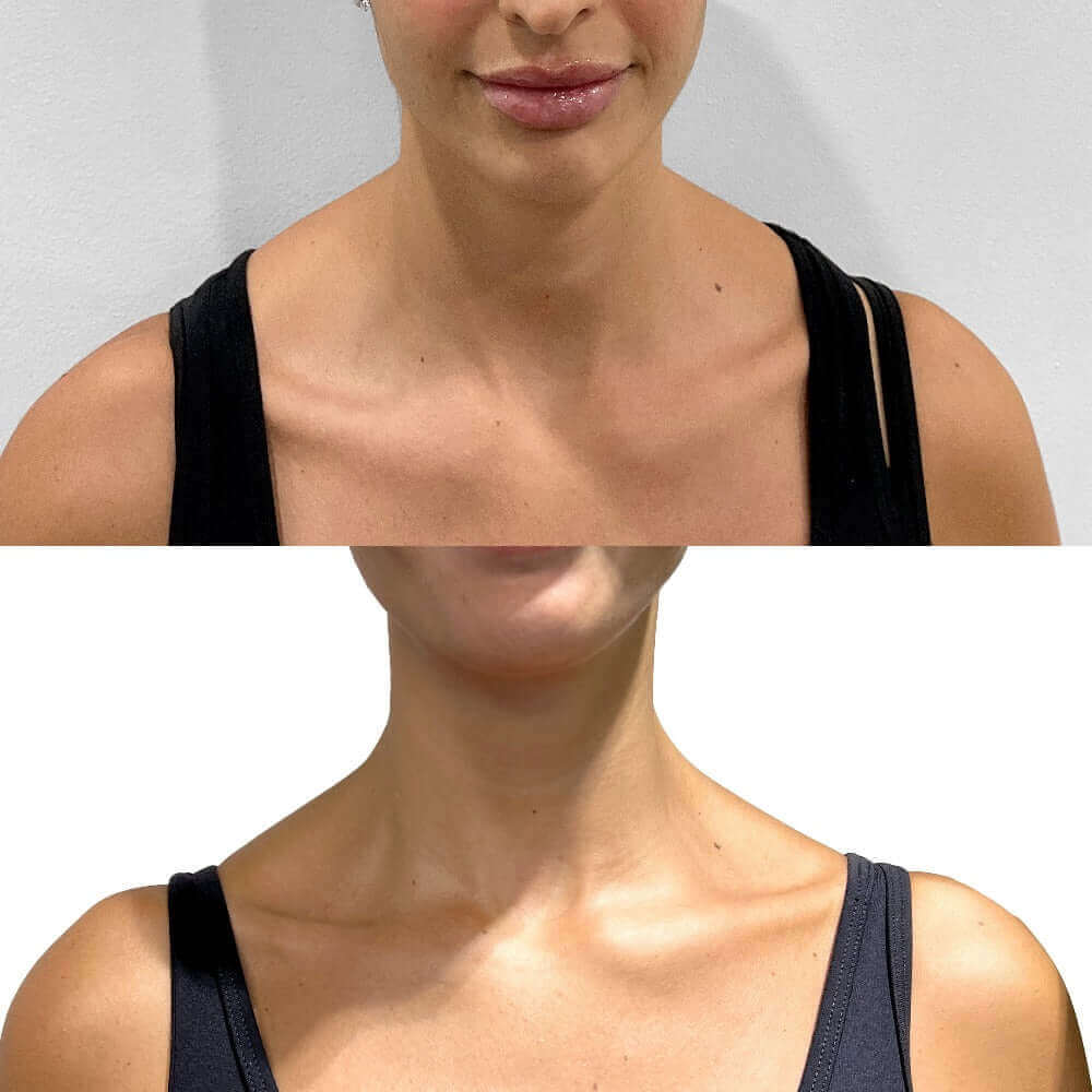 Barbie Botox before-after Los Angeles