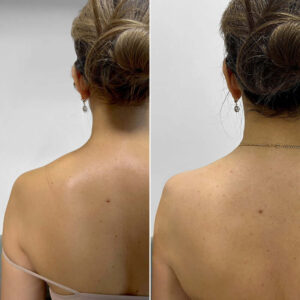 Barbie Botox injections before-after Los Angeles