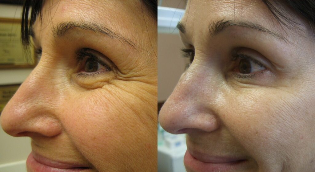 anti-wrinkles injection with dermal fillers Los Angeles