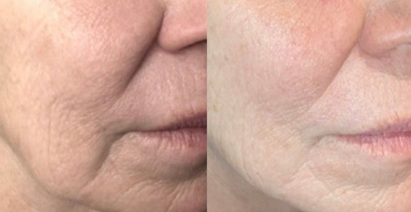 coolpeel-before-and-after-wrinkles Los Angeles