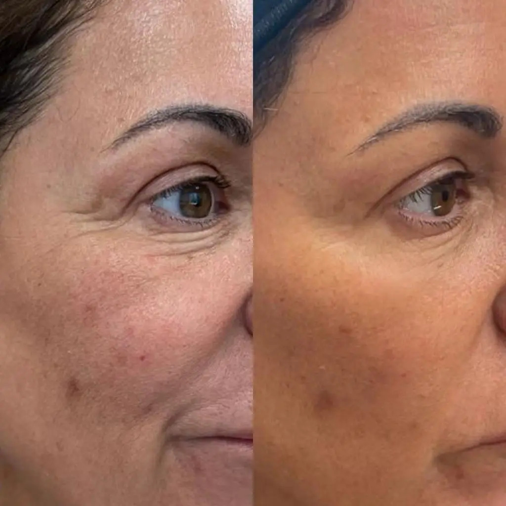 facial-lines-treatments-Morpheus 8-before-after-Los Angeles