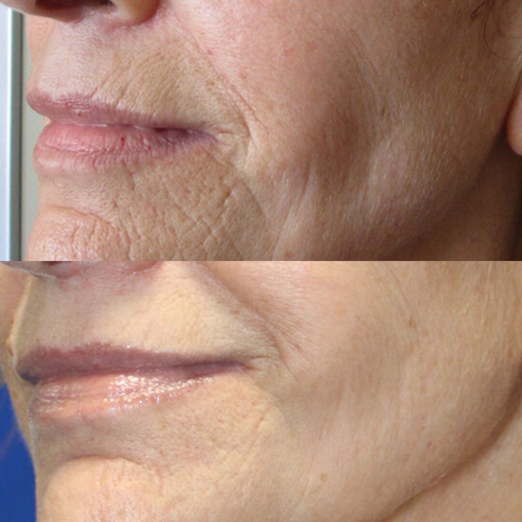 microneedling-before-and-after-wrinkles-treatments Los Angeles