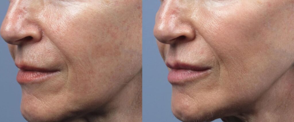 skin tightening with Lumecca-before-after Los Angeles