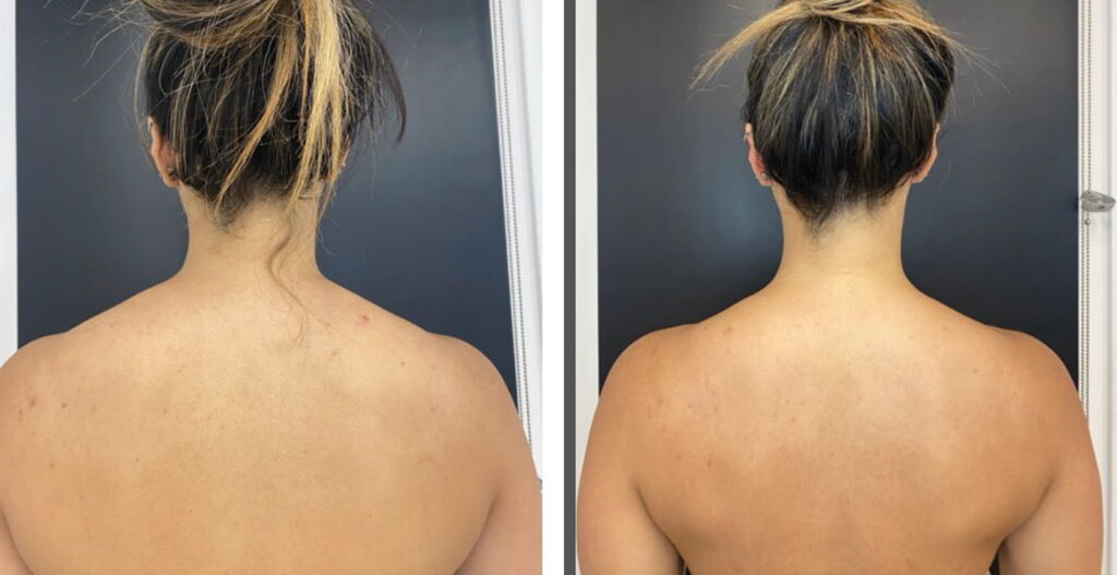 trapezius botox injections Los Angeles