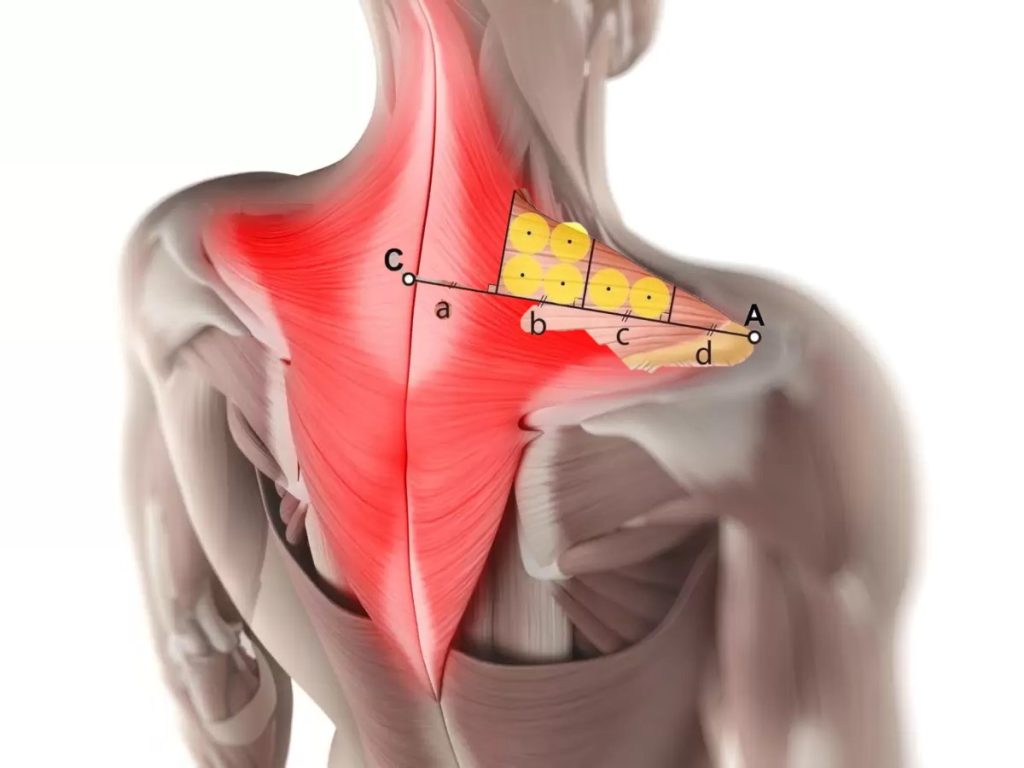 trapezius muscle injection Los Angeles