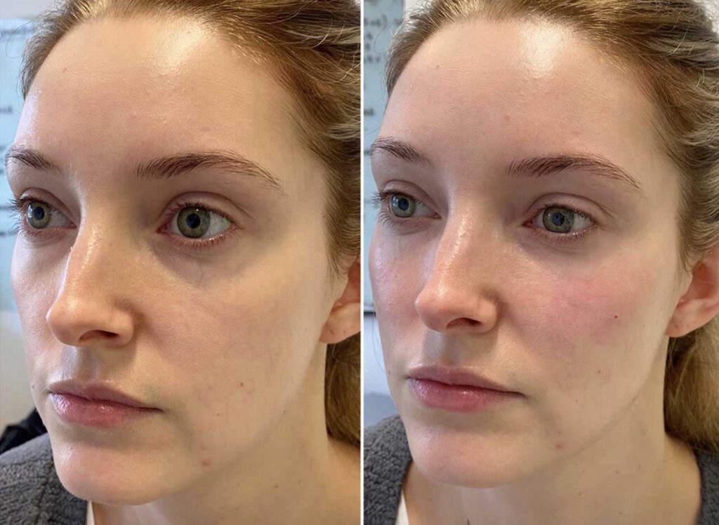 Dermal fillers before-after Los Angeles