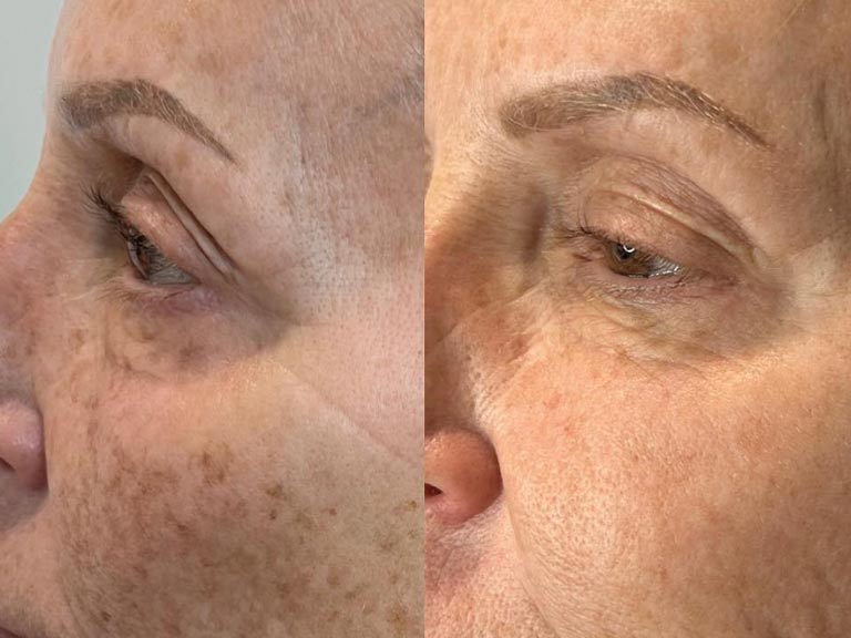 Lumecca IPL for dark spots before-after Los Angeles