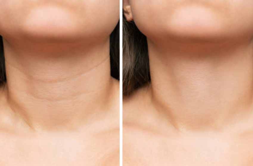 Nefertiti-Neck-Lift-before-after Los Angeles