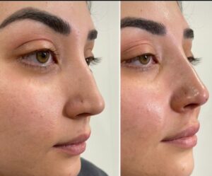 Non-surgical nose thread lift before-after Los Angeles