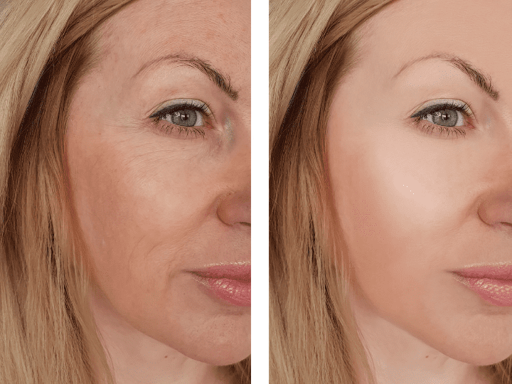 benefits of dermal fillers for drooping skin Los Angeles