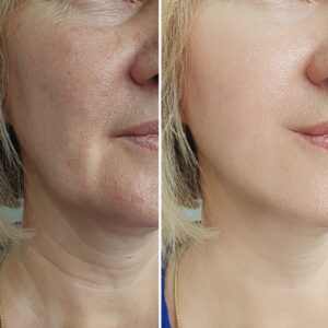 dermal filler before-after Los Angeles