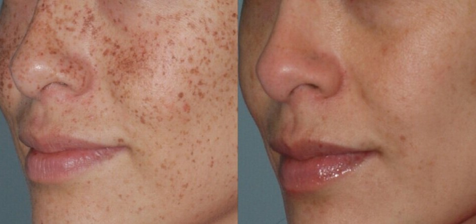 freckle removal with Lumecca IPL before-after Los Angeles