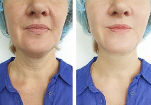 non-surgical neck lift with Morpheus8 Los Angeles