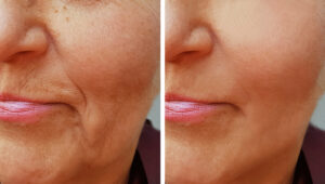 restore lost face volume with dermal fillers