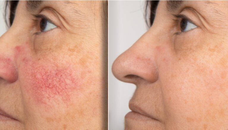 IPL-Treatment-before-after Los Angeles