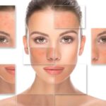 Lumecca IPL A powerful treatment for redness on the face Los Angeles