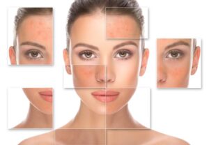 Lumecca IPL A powerful treatment for redness on the face Los Angeles