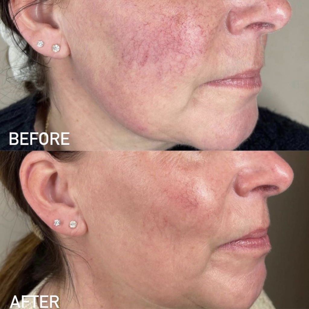 Lumecca IPL laser treatment for redness on the face Los Angeles