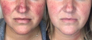 Lumecca IPL- powerful treatment for facial redness Los Angeles