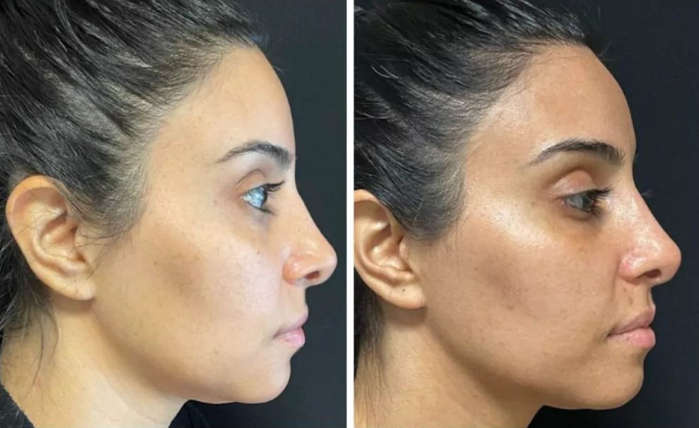 Morpheus8-RF-microneedling-Uneven-skin-tone-before-after-Los Angeles